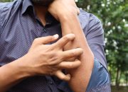 6 Ciri-Ciri Digigit Kutu Busuk yang Perlu Anda Ketahui