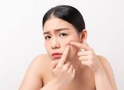 Jerawat Membandel? Ini Cara Mengatasinya!